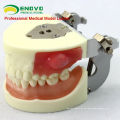 Oral Surgery Area Trainingsmodell Inzisionspus Removal Practice Model 12605